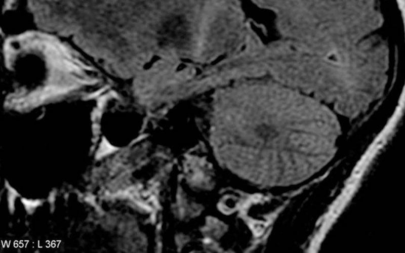 Investigación de enfermedades neurodegenerativas recibe 1.5 millones de euros