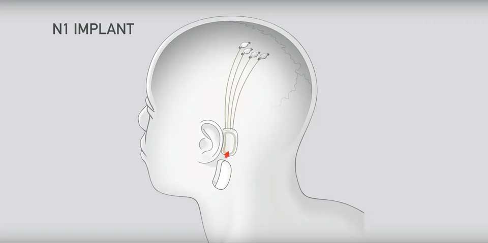 El chip Neuralink se coloca detrás de la oreja.