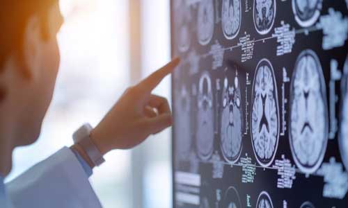El modelo distingue la ELA de otras enfermedades neuromusculares con más del 99% de precisión. (Imagen Ilustrativa Infobae)